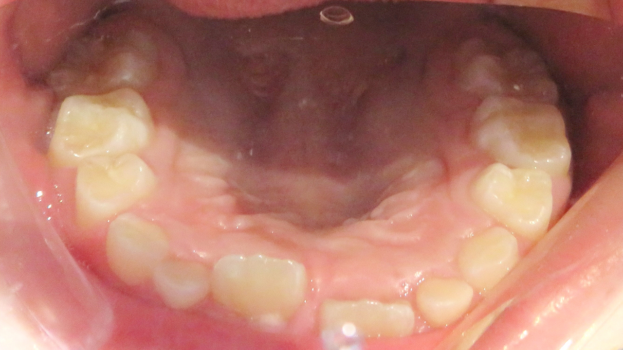 大阪市鶴見区の受け口・反対咬合の症例