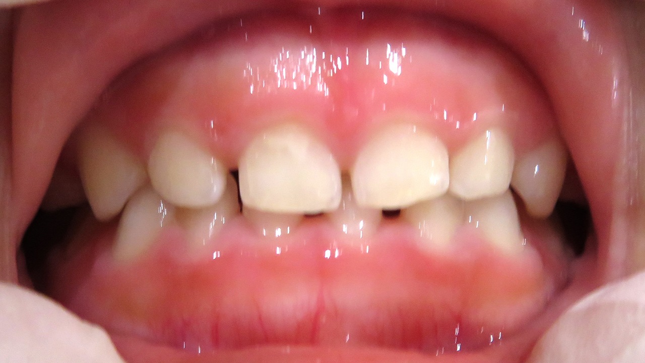 大阪市鶴見区の受け口・反対咬合の症例