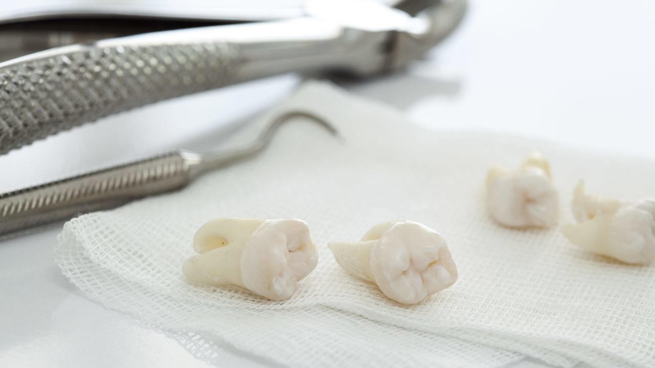 大阪市鶴見区の親知らずの抜歯・治療