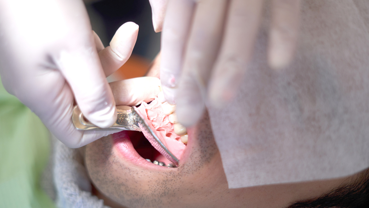 大阪市鶴見区の入れ歯治療