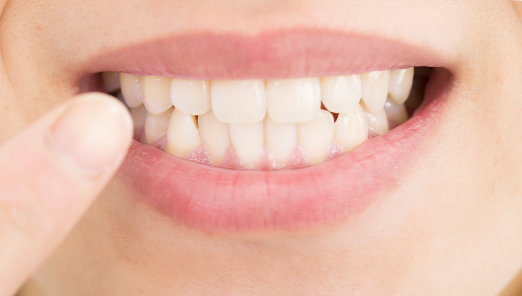 大阪市鶴見区のホームホワイトニング