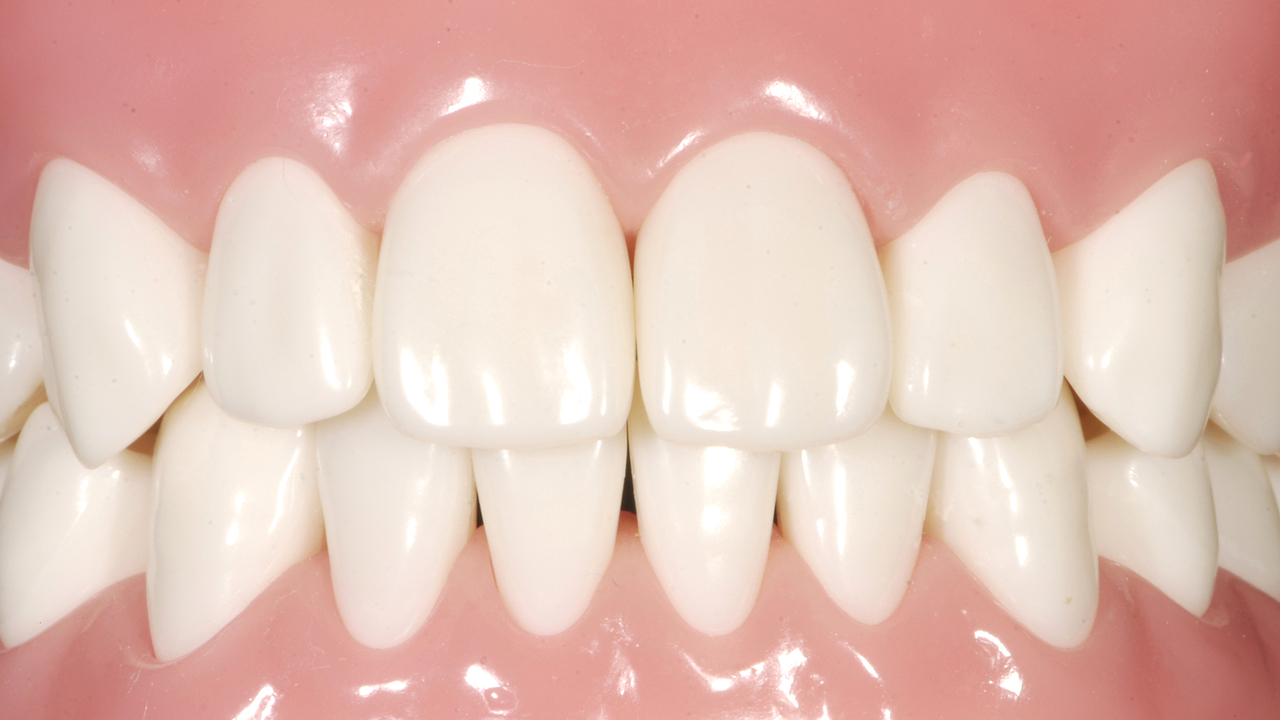 大阪市鶴見区のCAD/CAM（保険の白い詰め物・被せ物）