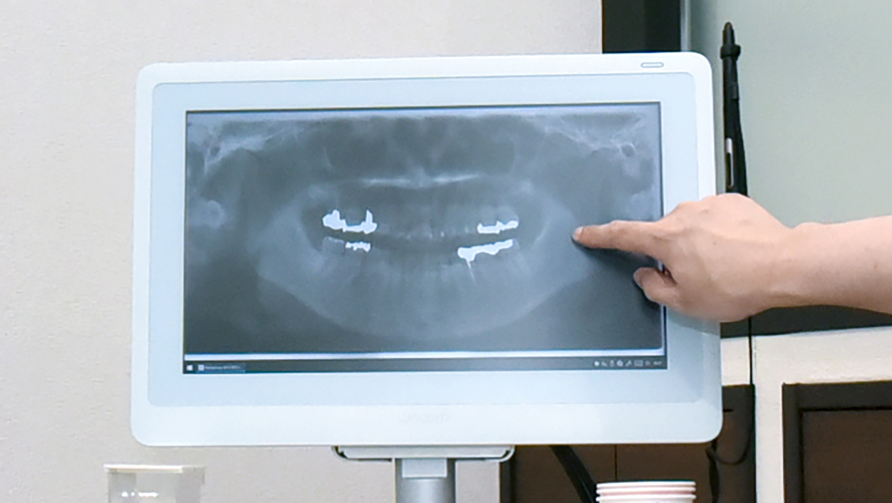 大阪市鶴見区の歯ぎしり・食いしばりの治療（ナイトガード）