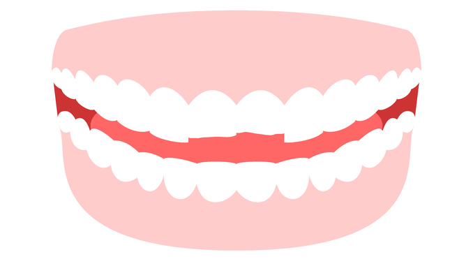 大阪市鶴見区の歯ぎしり・食いしばりの治療（ナイトガード）
