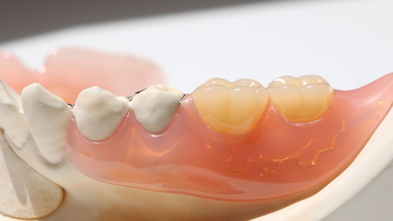 大阪市鶴見区のノンクラスプデンチャー