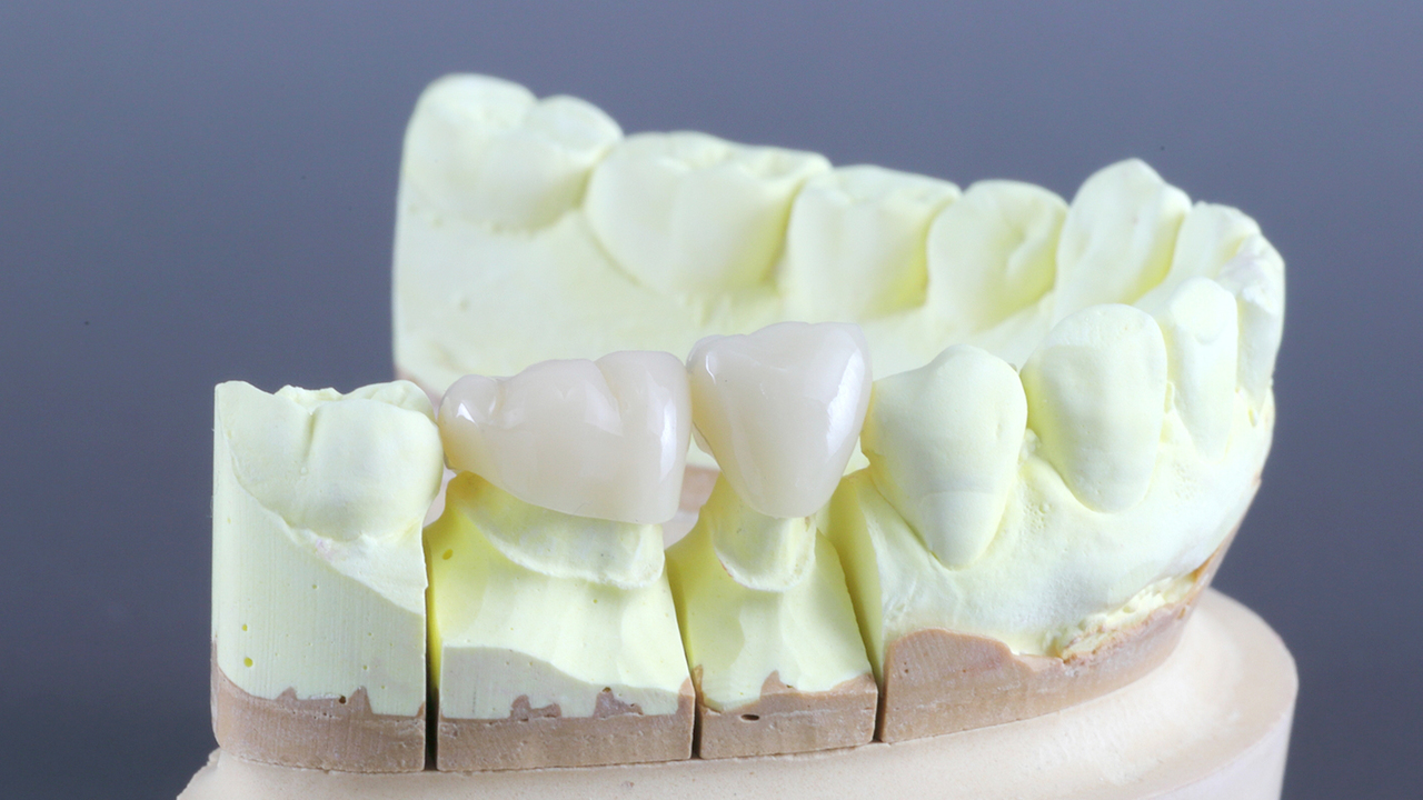 大阪市鶴見区のCAD/CAM（保険の白い詰め物・被せ物）