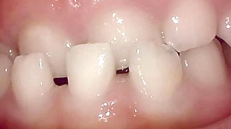 大阪市鶴見区の受け口・反対咬合の症例