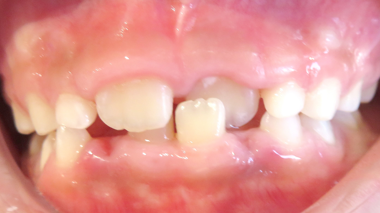 大阪市鶴見区の受け口・反対咬合の症例