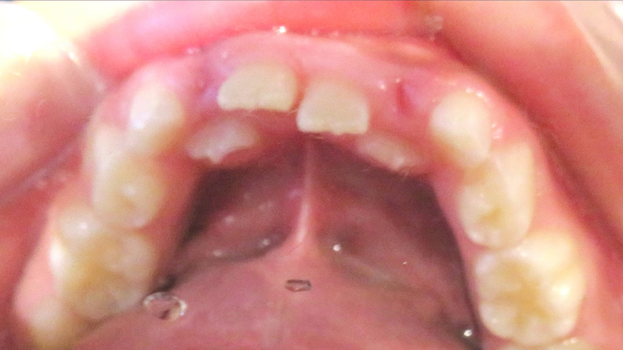 大阪市鶴見区の受け口・反対咬合の症例