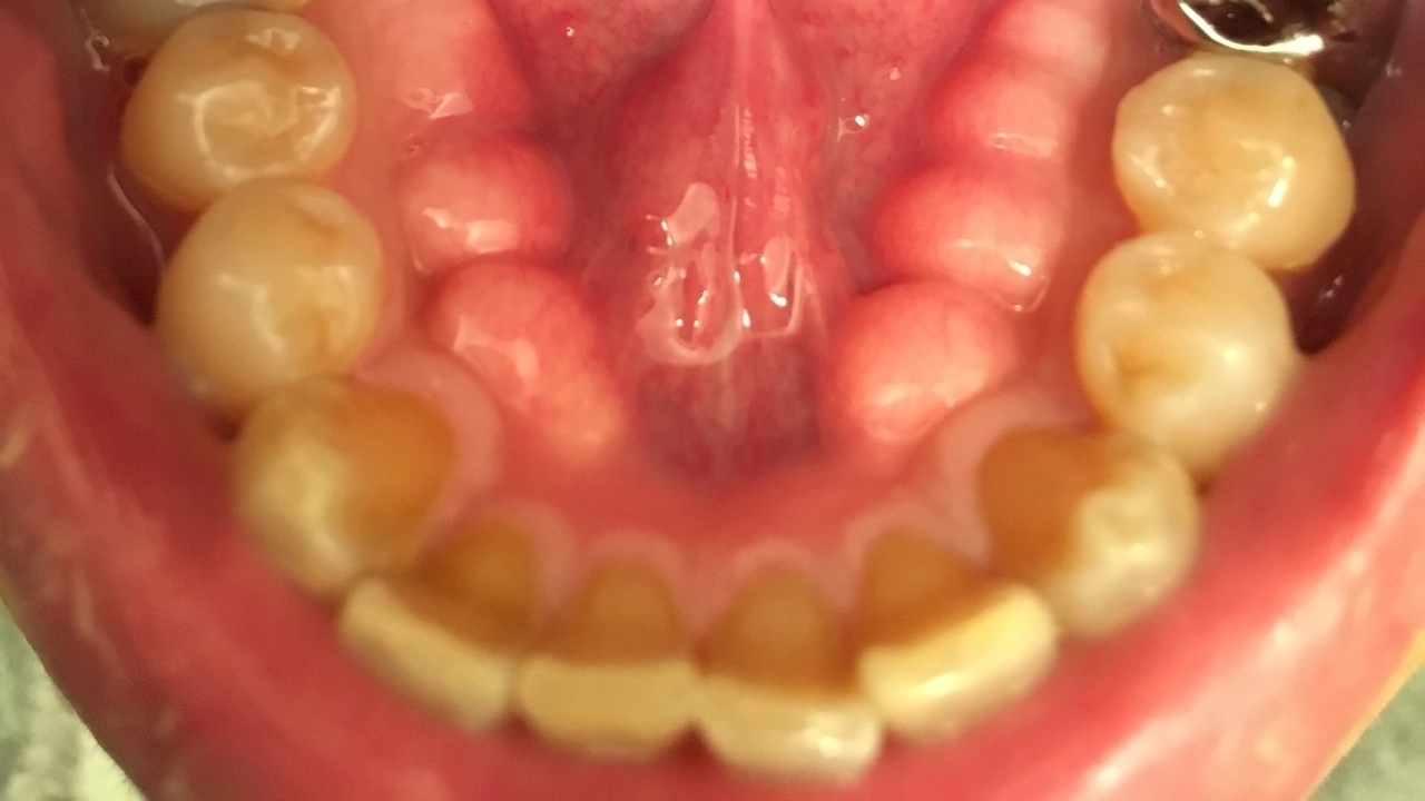 大阪市鶴見区の歯ぎしり・食いしばりの治療（ナイトガード）