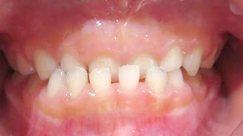 大阪市鶴見区の受け口・反対咬合の症例