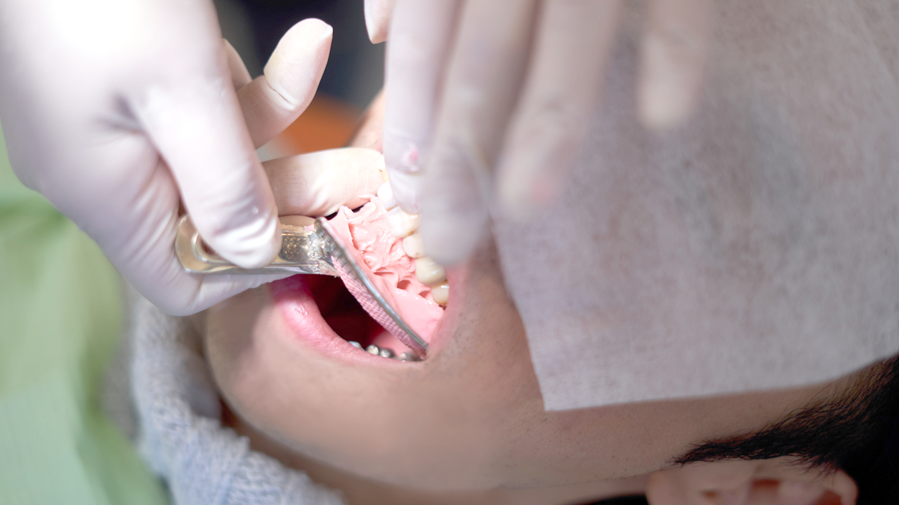 大阪市鶴見区の歯ぎしり・食いしばりの治療（ナイトガード）