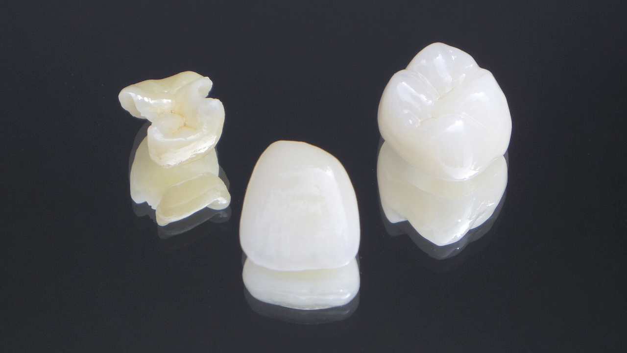 大阪市鶴見区のCAD/CAM（保険の白い詰め物・被せ物）