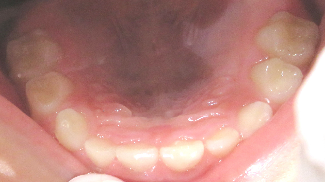 大阪市鶴見区の受け口・反対咬合の症例